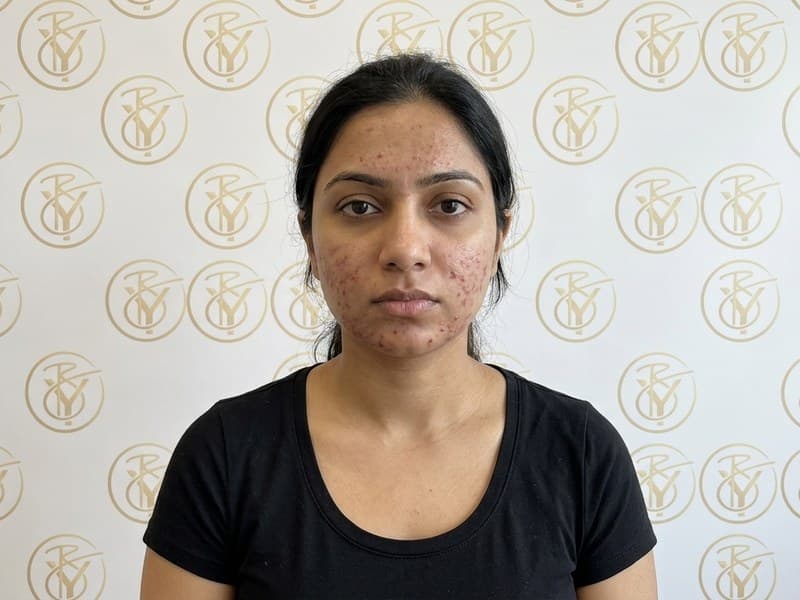 Acne Treatment — before