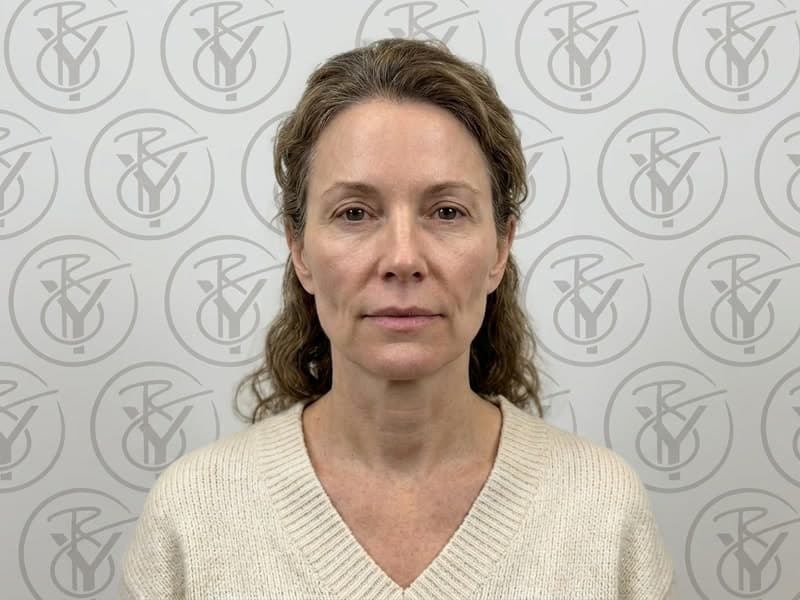 Dermal Fillers — before