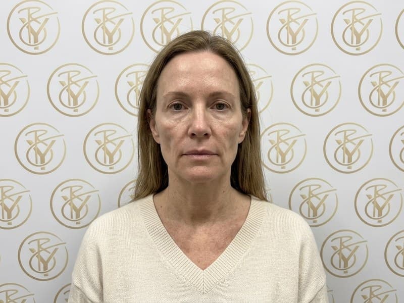 Dermal Fillers — before
