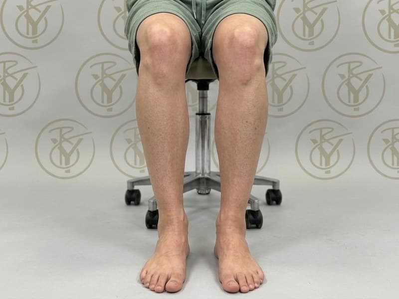 Laser Hair Removal — after