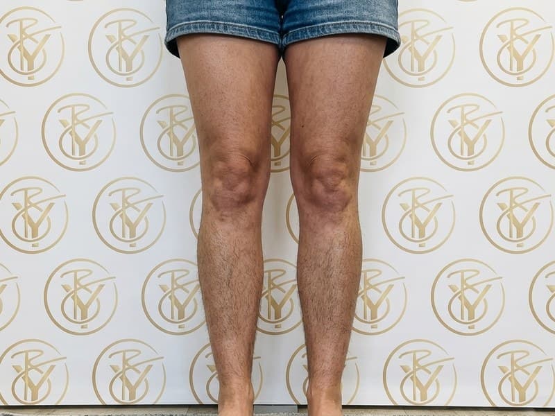 Laser Hair Removal — before