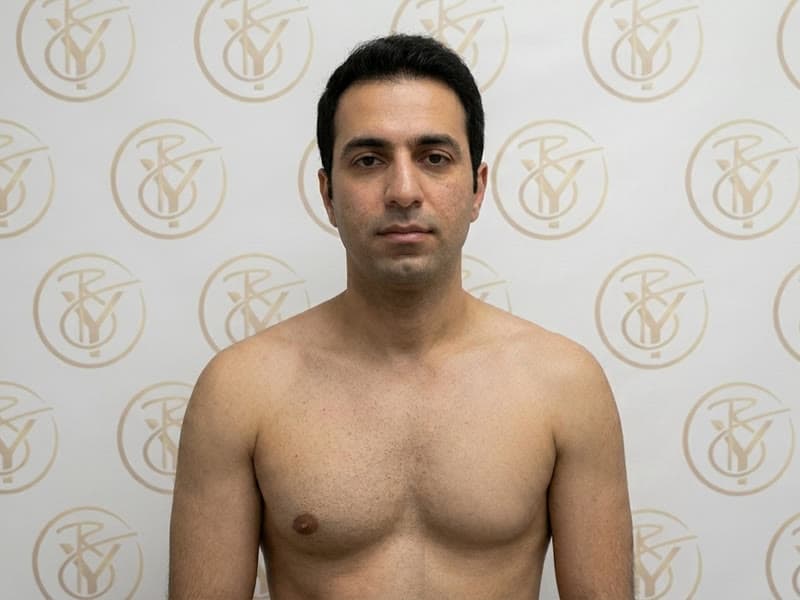 Laser Hair Removal — after