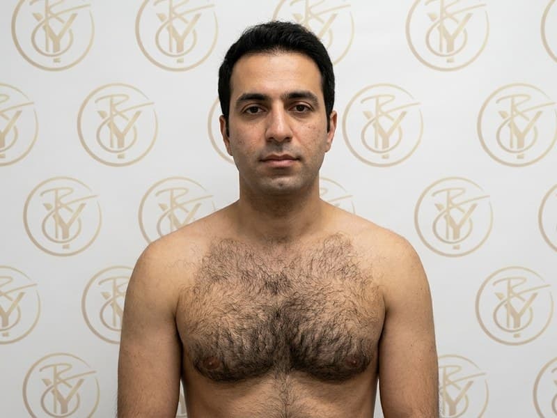 Laser Hair Removal — before