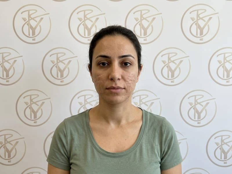Microneedling — before