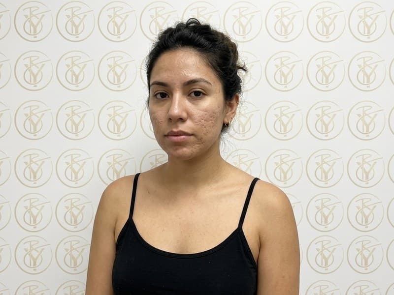 Microneedling — before