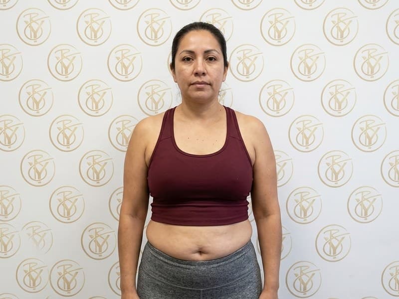 Ultrasonic Cavitation — before