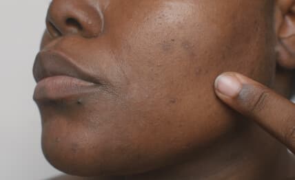 Persistent acne affecting self-esteem.
