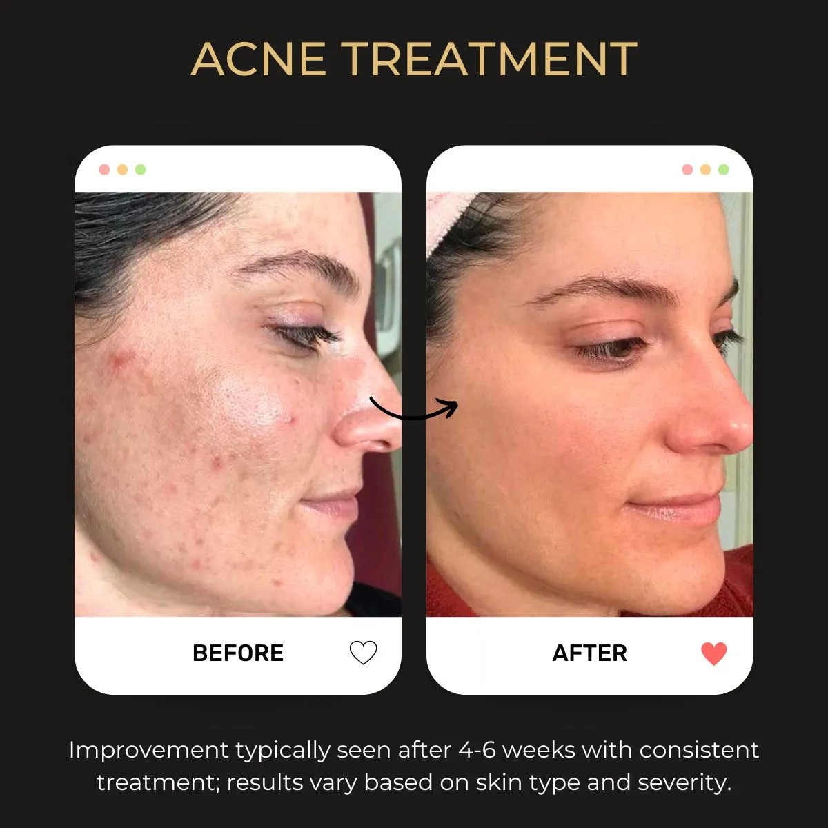 Acne treatment before and after — Be You Esthetic Suites.
