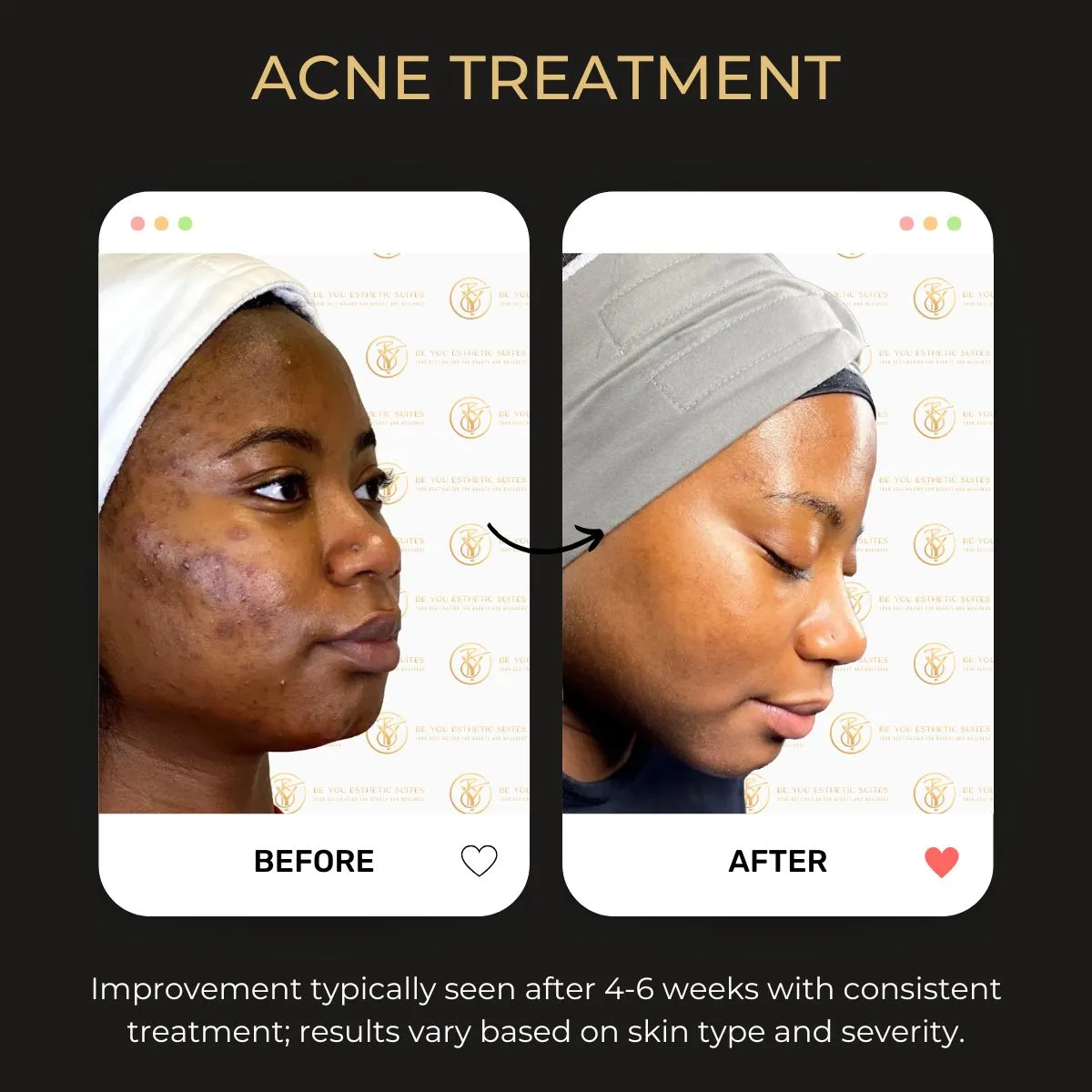 Acne treatment before and after — Be You Esthetic Suites.