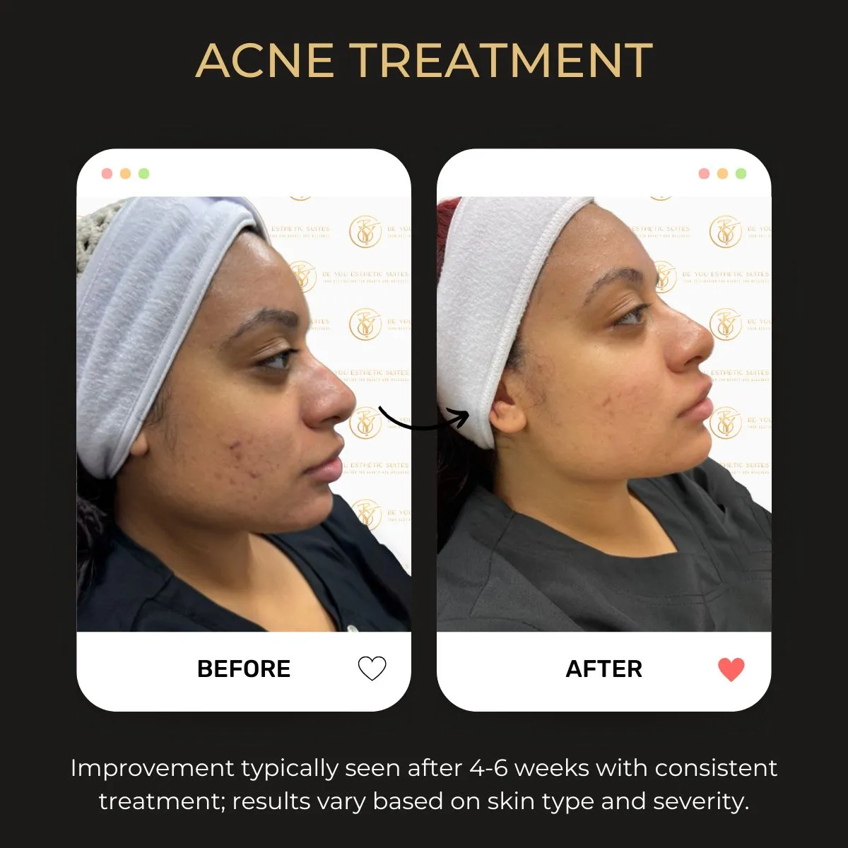 Acne treatment before and after — Be You Esthetic Suites.