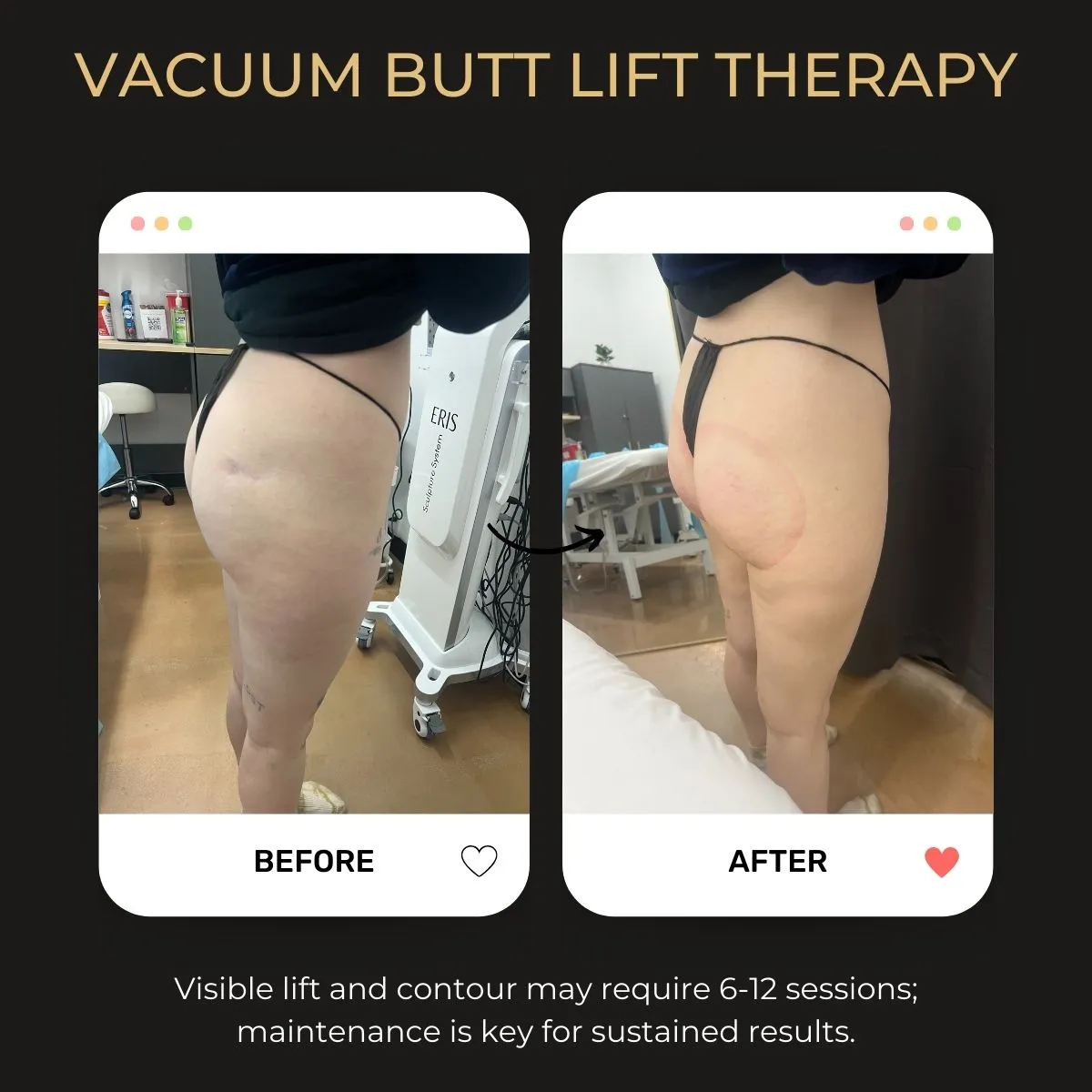 Vacuum butt lift before and after — Be You Esthetic Suites.