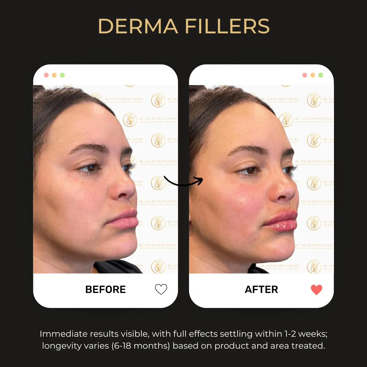 Derma Fillers before and after — Be You Esthetic Suites.