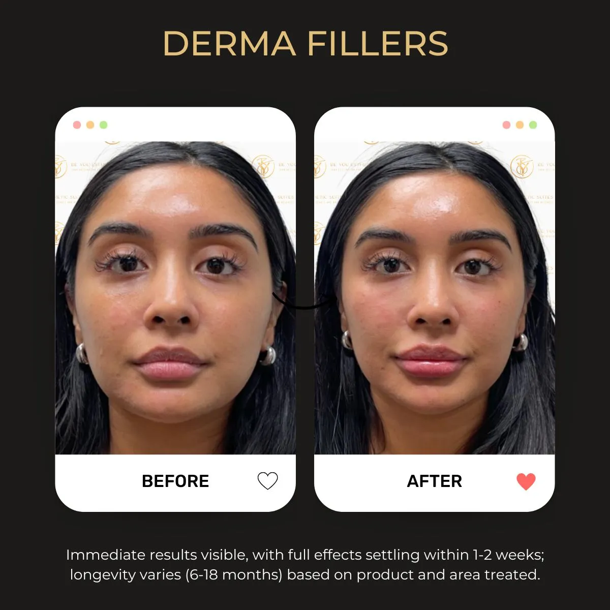 Derma Fillers before and after — Be You Esthetic Suites.