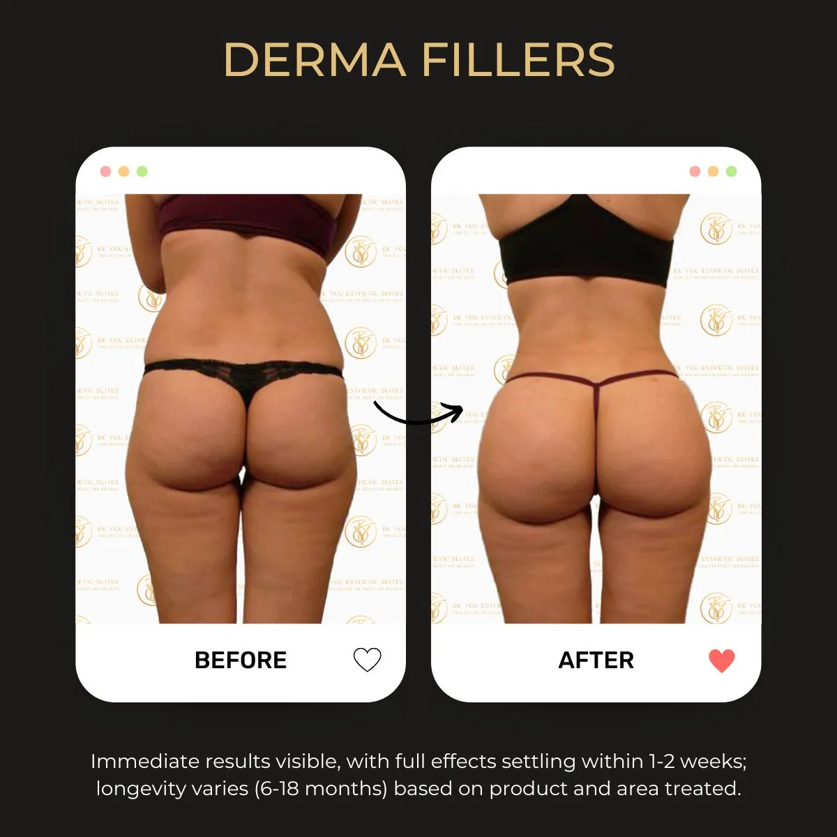 Derma Fillers before and after — Be You Esthetic Suites.