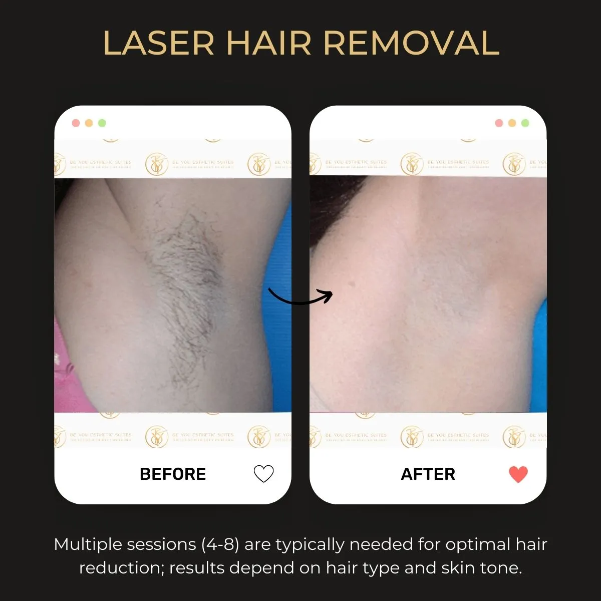 Laser hair removal before and after — Be You Esthetic Suites.