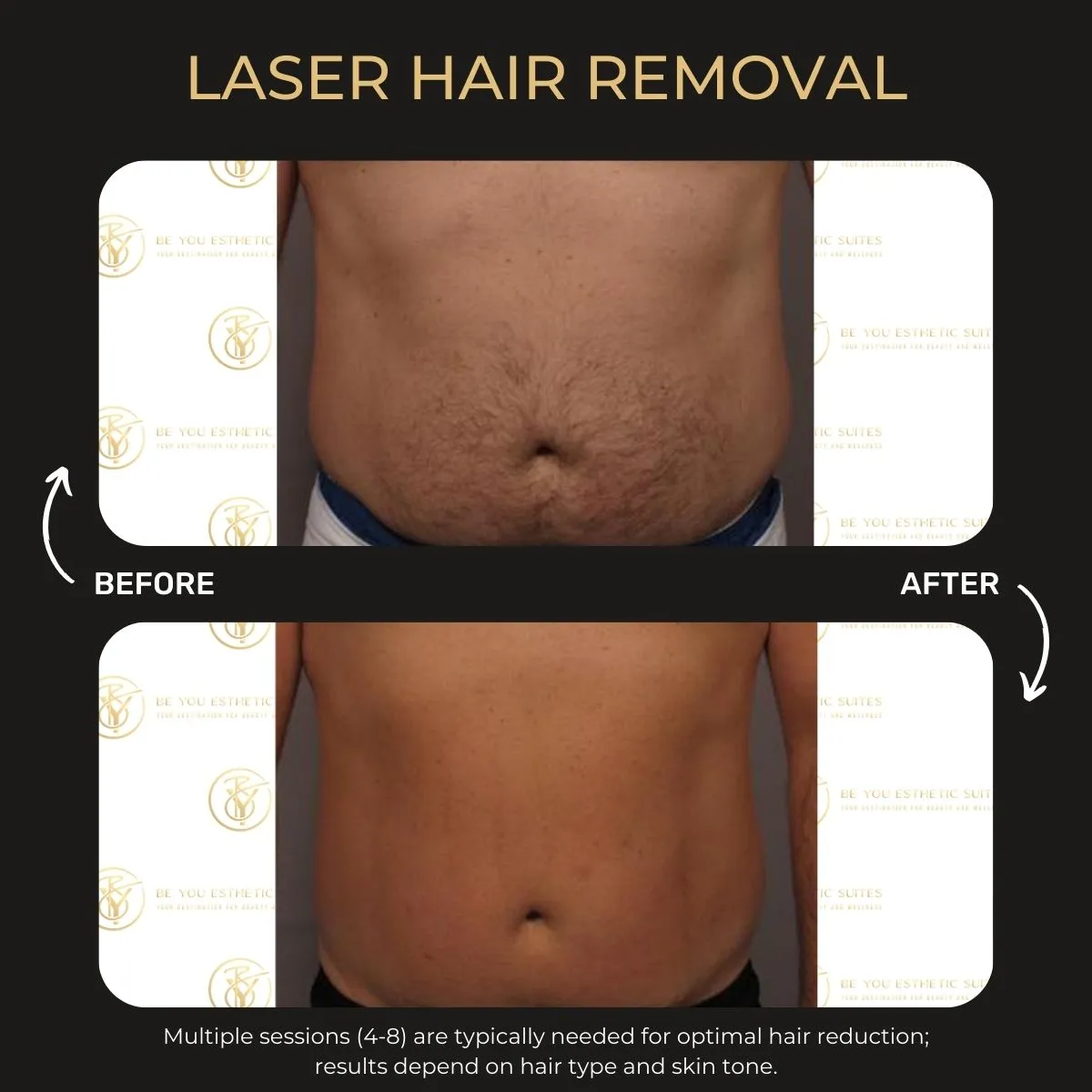 Laser hair removal before and after — Be You Esthetic Suites.