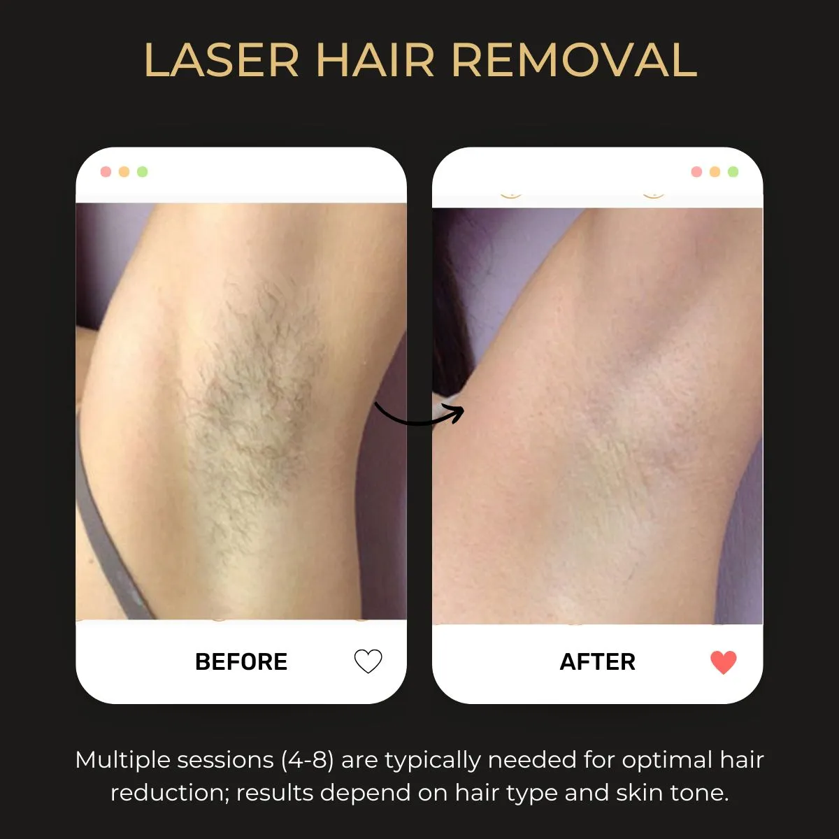 Laser hair removal before and after — Be You Esthetic Suites.