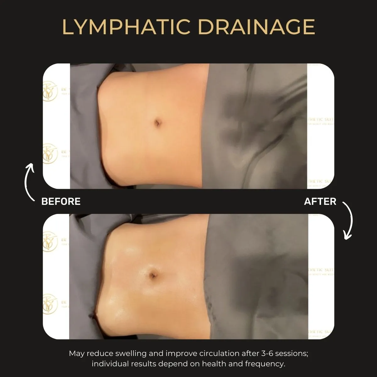 Manual lymphatic drainage before and after — Be You Esthetic Suites.