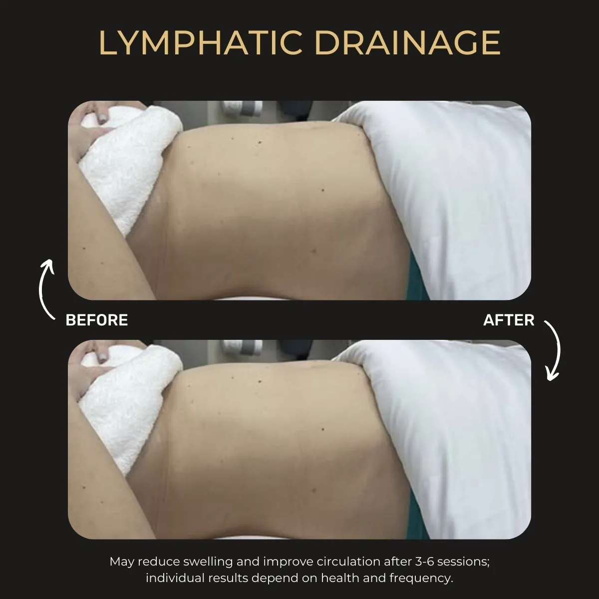 Manual lymphatic drainage before and after — Be You Esthetic Suites.