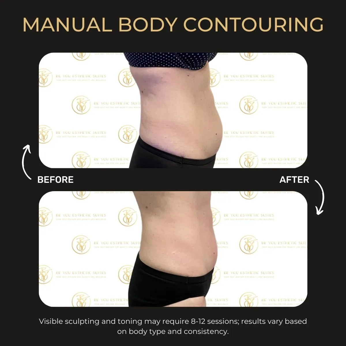 Manual body contouring before and after — Be You Esthetic Suites.