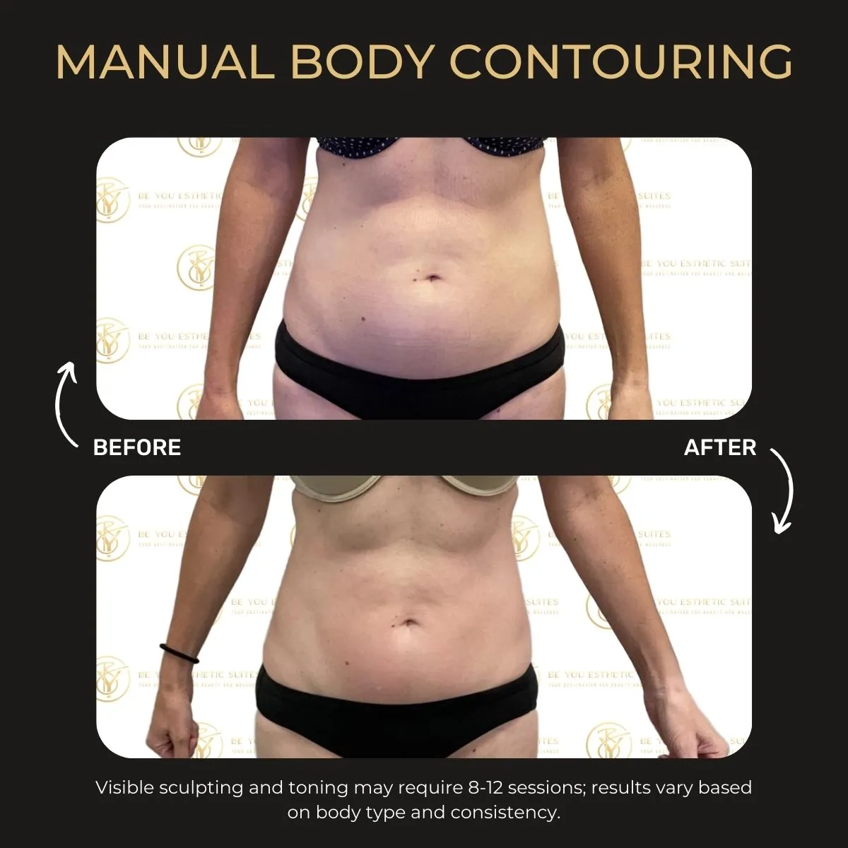 Manual body contouring before and after — Be You Esthetic Suites.