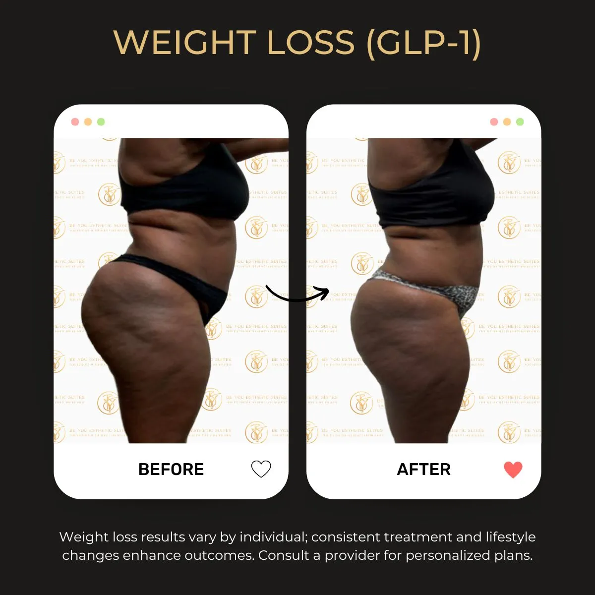 Weight loss program before and after — Be You Esthetic Suites.