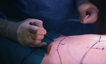 Fuller, more contoured appearance without surgery.