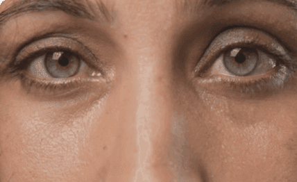 Time showing on your face — Botox.