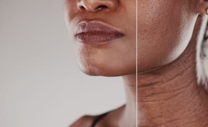 Signs of aging — chemical peels.