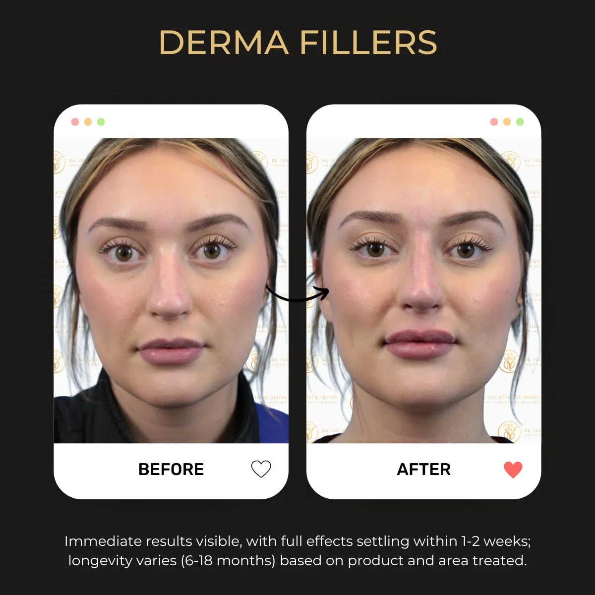 Female model before and after derma fillers at Be You Esthetic Suites, highlighting skin improvement.