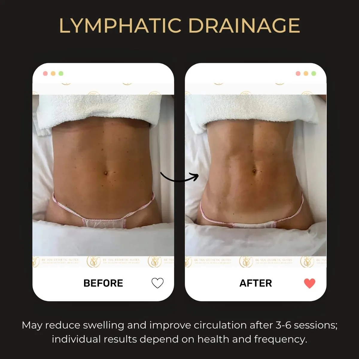 Before and after lymphatic drainage results.