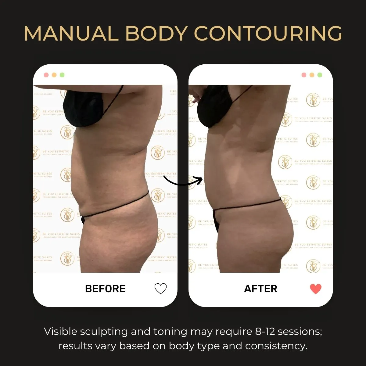 Before and after manual body contouring at Be You Esthetic Suites.