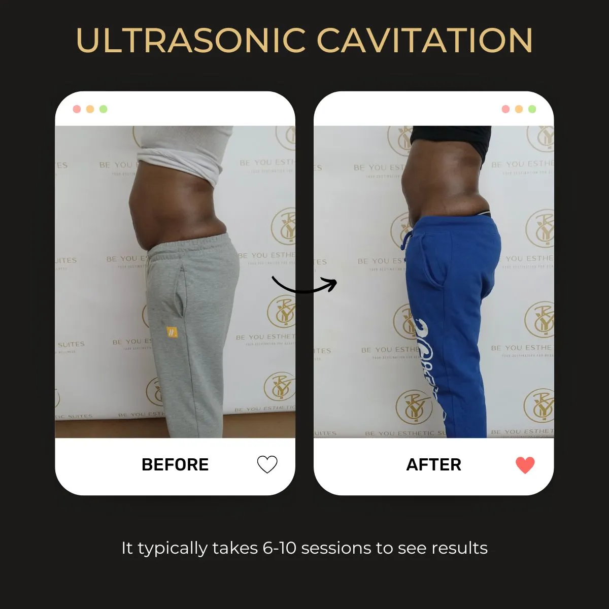 Ultrasonic Cavitation treatment at Be You Esthetic Suites.