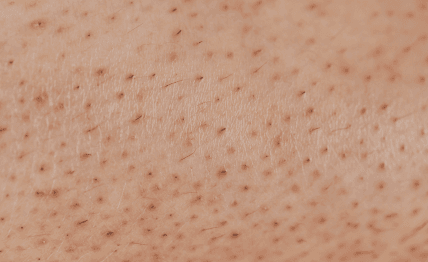 Tired of shaving, waxing, and ingrown hairs.