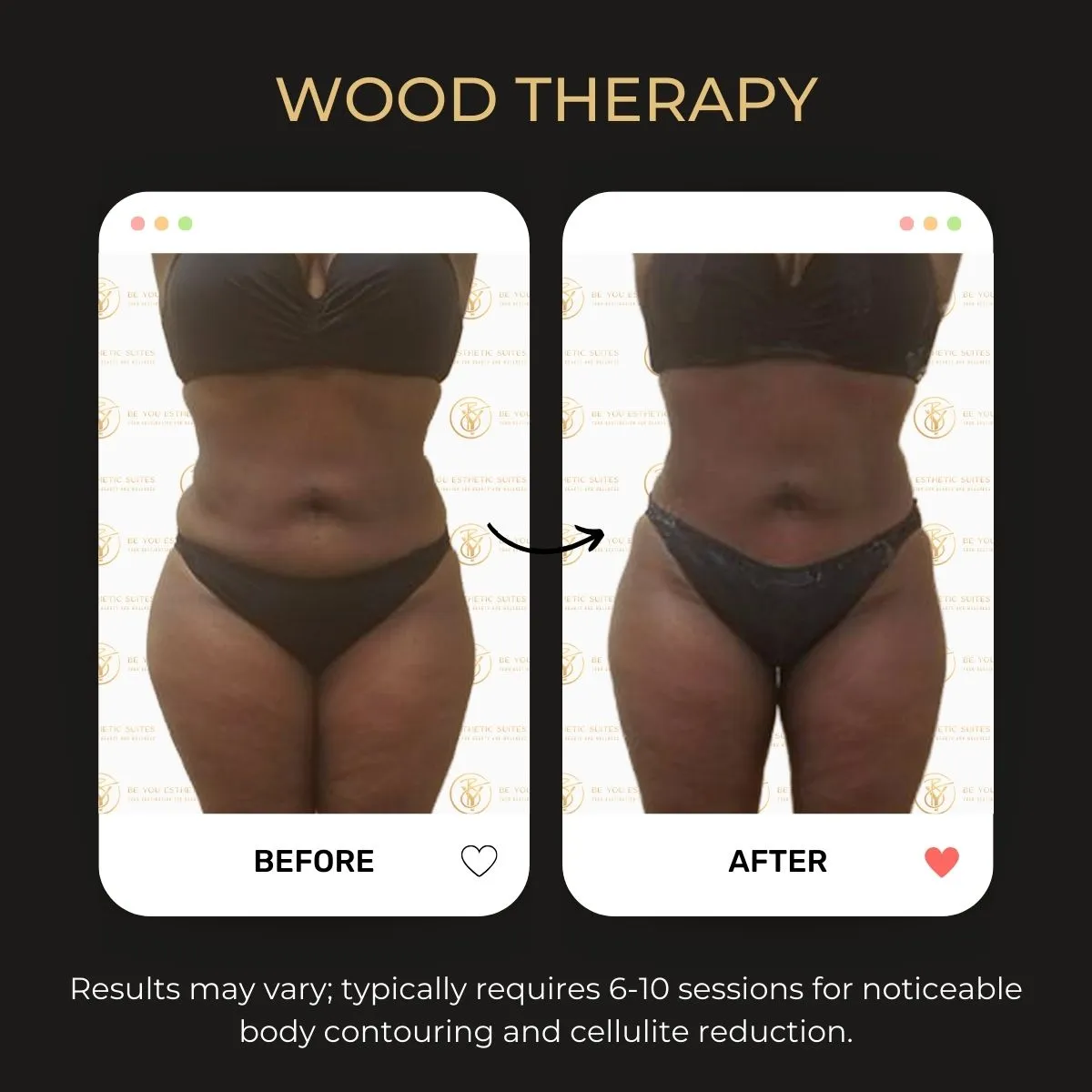 Before and after body transformation images from Wood Therapy at Be You Esthetic Suites.
