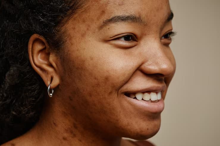 Close-up profile of a woman's face showing facial hyperpigmentation and dark spots that can be treated with professional facials at Be You Esthetic Suites in Brooklyn, NY.